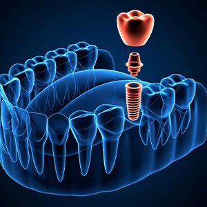a 3D illustration demonstrating the osseointegration process