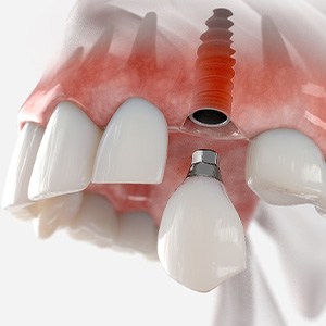 a 3D illustration of a dental implant restoration